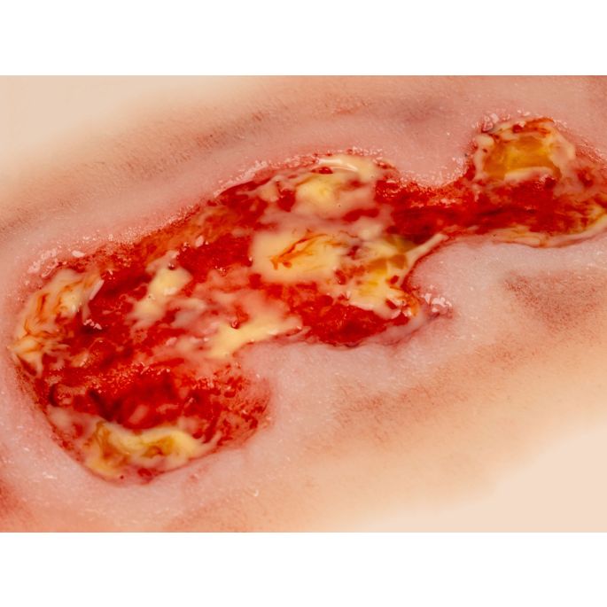 Wondmoulage veneuze beenulcus