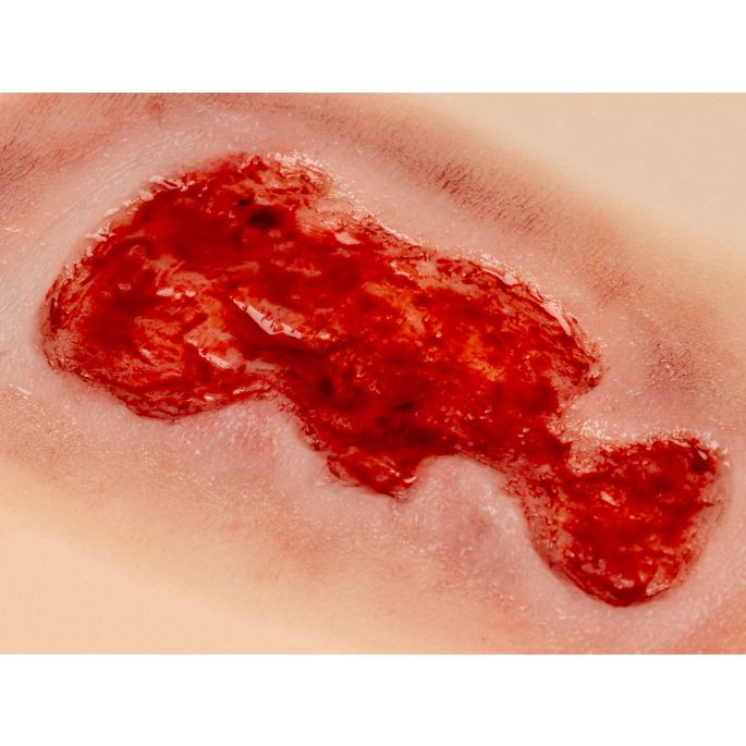 Wondmoulage veneuze beenulcus