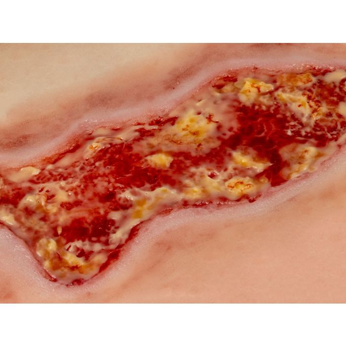 Wondmoulage veneuze beenulcus