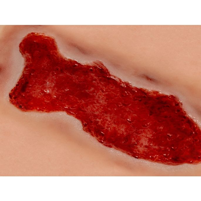 Wondmoulage veneuze beenulcus