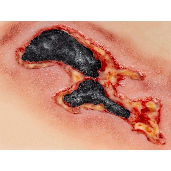 Wondmoulage arteriële beenulcus