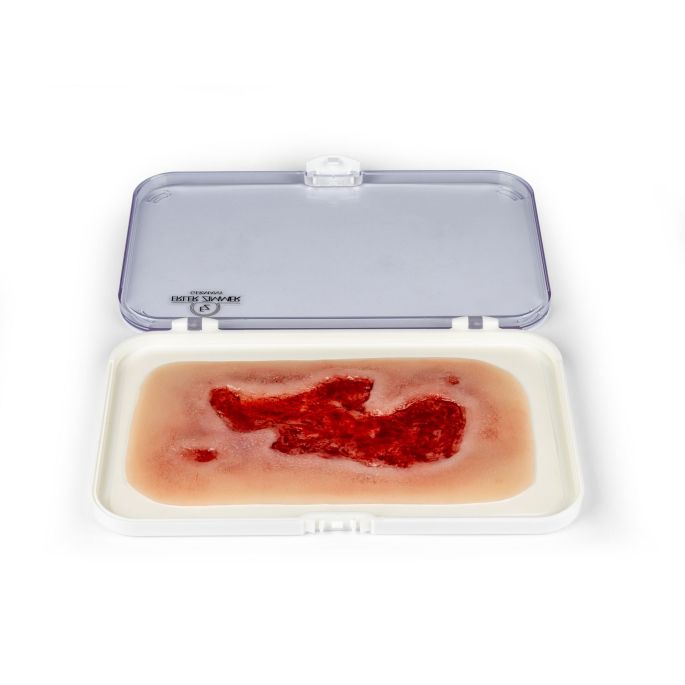 Wondmoulage arteriële beenulcus