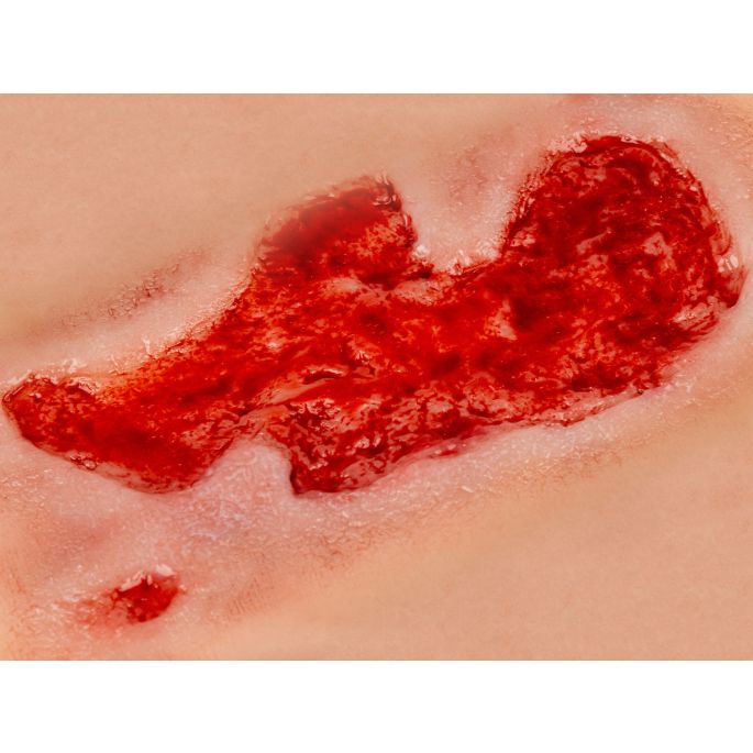 Wondmoulage arteriële beenulcus