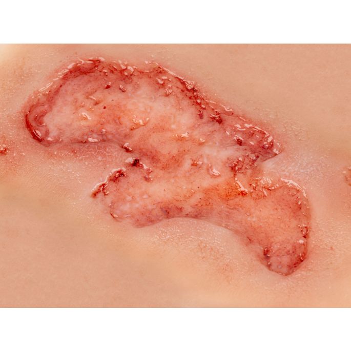 Wondmoulage arteriële beenulcus