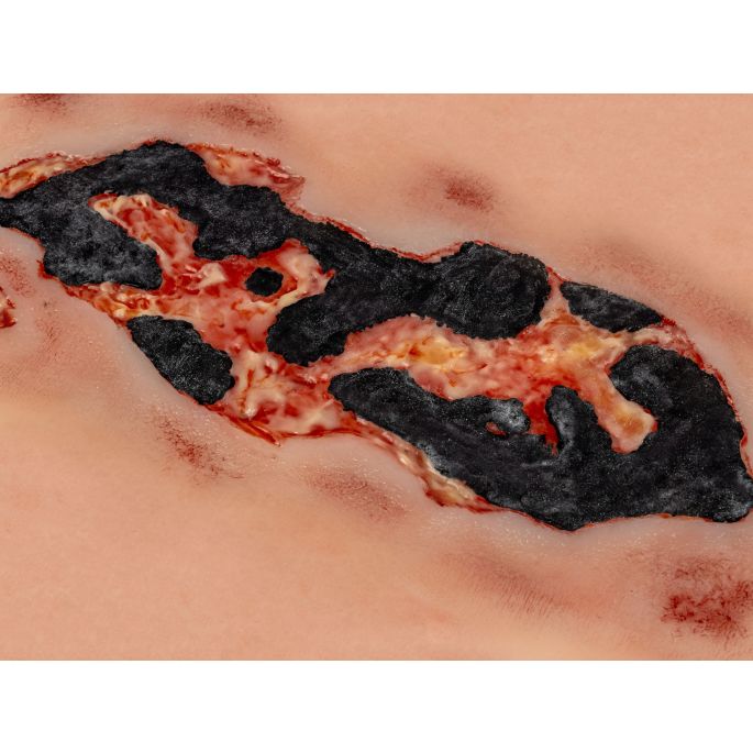 Wondmoulage arteriële beenulcus