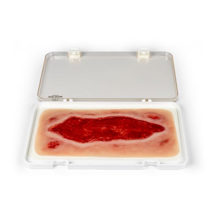 Wondmoulage arteriële beenulcus