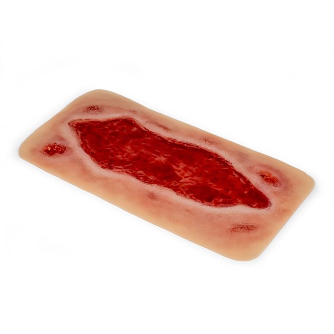 Wondmoulage arteriële beenulcus