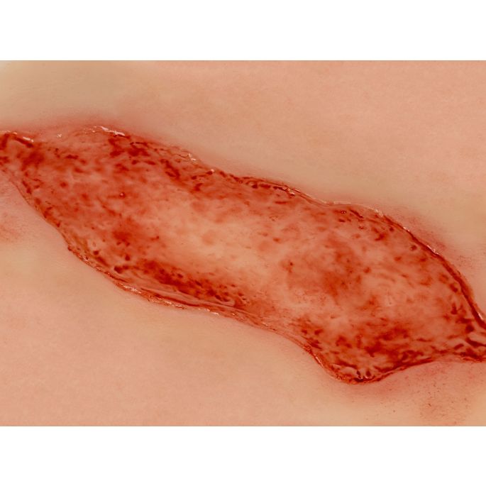 Wondmoulage arteriële beenulcus