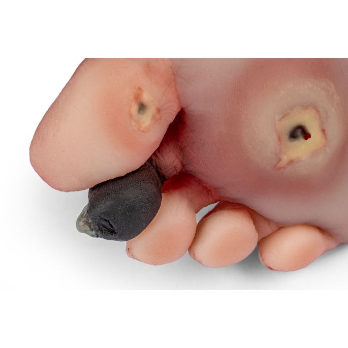 Wondvoet met diabetisch voetsyndroom - afbeelding 8