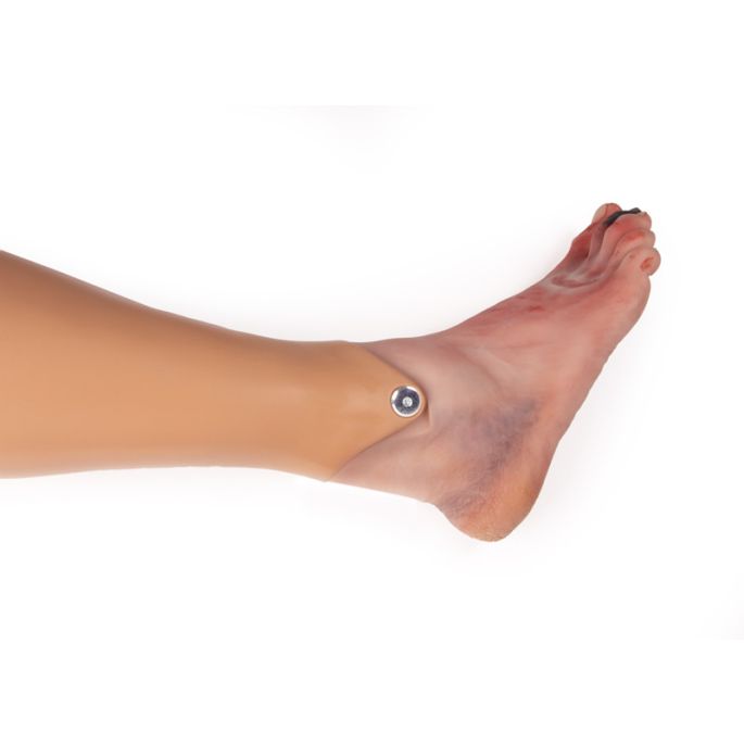 Wondvoet met diabetisch voetsyndroom