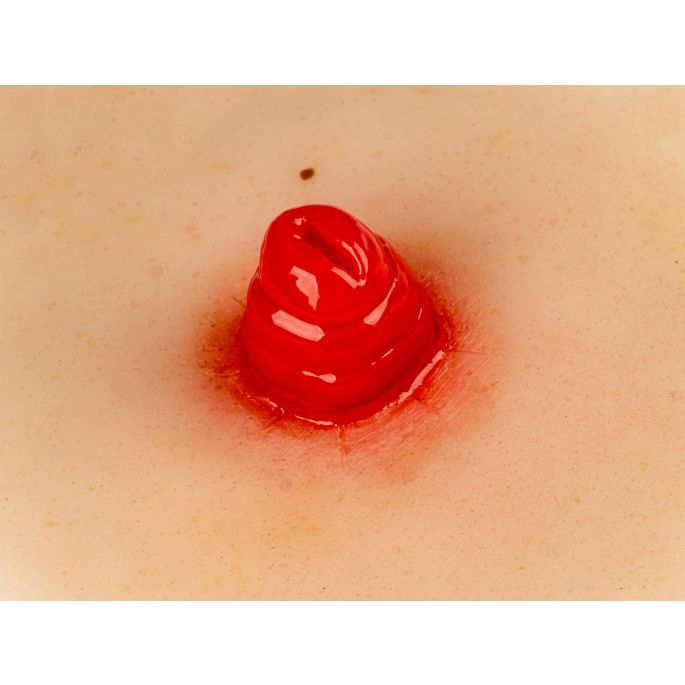 Wondmoulage ileostoma, zelfklevend