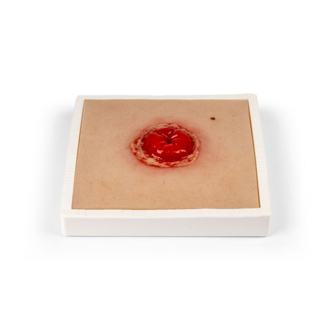 Wondmoulage Colostoma met ontsteking