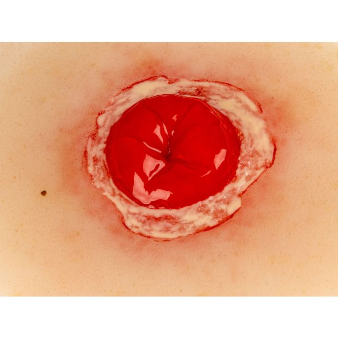 Wondmoulage ontstoken colostoma, zelfklevend