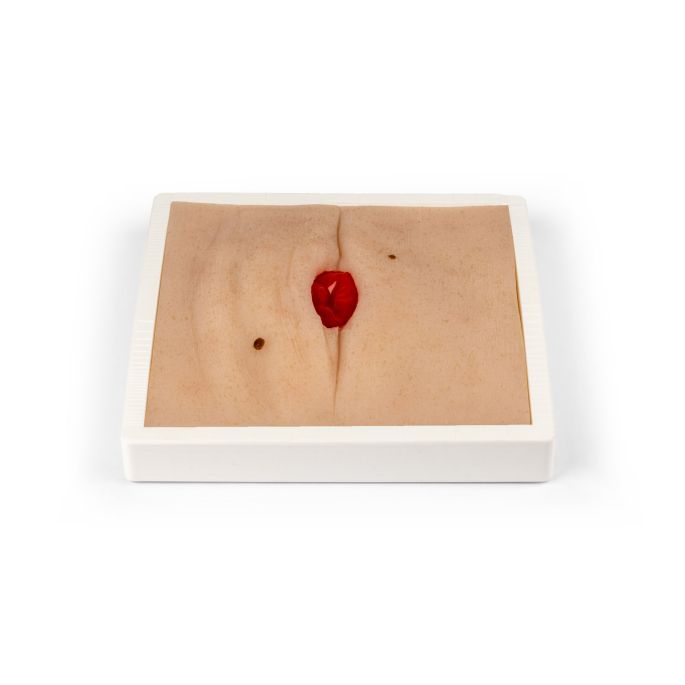 Wondmoulage Colostoma in buikplooi