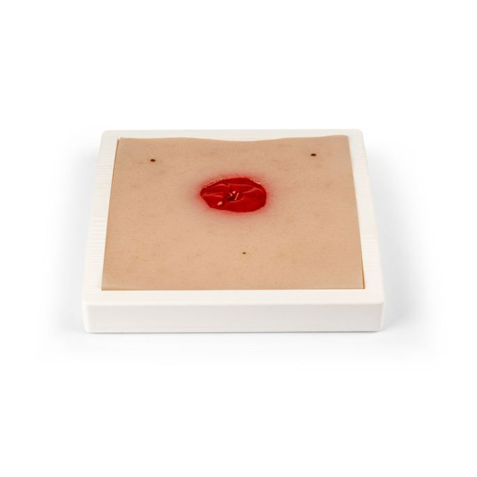 Wondmoulage Colostoma onder huidniveau