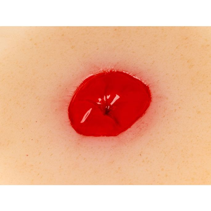 Wondmoulage verzonken colostoma, zelfklevend