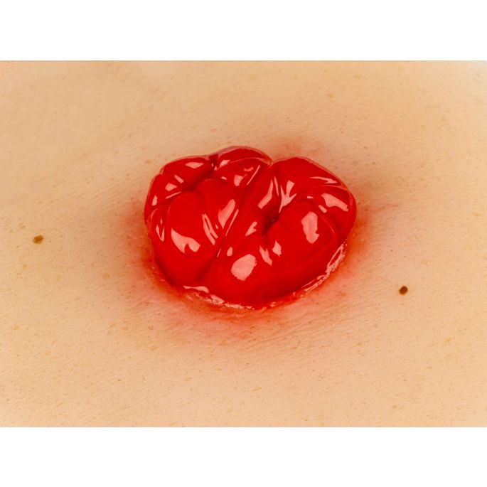 Wondmoulage dubbelloops colostoma, zelfklevend