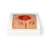 Wondmoulage sacrale decubitus