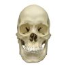 Scaphocefale schedel (craniosynostose) - afbeelding 5