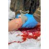 Trauma Tina, arm met sterk bloedende wonden