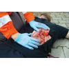 Wondmoulage laceratie, groot met bloedingsfunctie