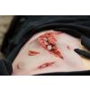 Wondmoulage laceratie, groot met bloedingsfunctie