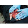 Wondmoulage laceratie, groot met bloedingsfunctie