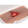 Wondmoulage open fractuur, been met bloedingsfunctie