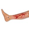 Wondmoulage veneuze beenulcus, groot, exsudatiefase