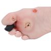 Wondvoet met diabetisch voetsyndroom
