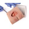 Wondmoulage sacrale decubitus, gereinigd inclusief standaard