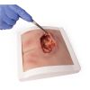 Wondmoulage sacrale decubitus, gereinigd inclusief standaard