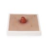 Wondmoulage Ileostoma, incl. stellage