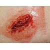 EZ-wonden – Basissimulatieset voor slachtoffers