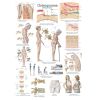 Osteoporoseposter