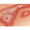 Wondmoulage broeien - afbeelding 5