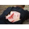 Wondmoulage laceratie