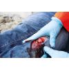 Wondmoulage open fractuur