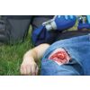 Wondmoulage open fractuur