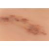 Wondmoulage hematoom vers - afbeelding 5