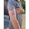 Wondmoulage hematoom vers - afbeelding 6