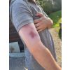 Wondmoulage hematoom vers - afbeelding 7