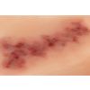 Wondmoulage Hematoom ouder - afbeelding 5
