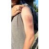 Wondmoulage Hematoom ouder - afbeelding 6