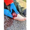 Wondpresentatie open fractuur enkelgewricht - afbeelding 7