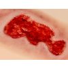 Wondmoulage veneuze beenulcus