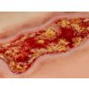 Wondmoulage veneuze beenulcus