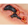 Wondmoulage arteriële beenulcus