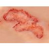 Wondmoulage arteriële beenulcus