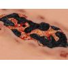 Wondmoulage arteriële beenulcus